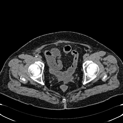 Acute appendicitis (Radiopaedia 58627-65818 Axial non-contrast 81).jpg