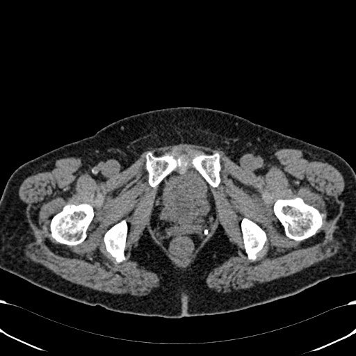 File:Acute appendicitis (Radiopaedia 58627-65818 Axial non-contrast 88).jpg