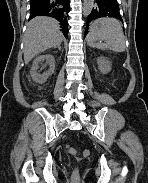 Acute appendicitis (Radiopaedia 58627-65818 Coronal non-contrast 50).jpg