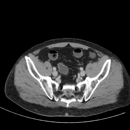 File:Acute appendicitis (Radiopaedia 66513-75790 Axial C+ portal venous phase 72).jpg
