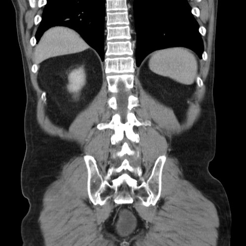 Acute appendicitis (Radiopaedia 66513-75790 Coronal C+ portal venous phase 72).jpg