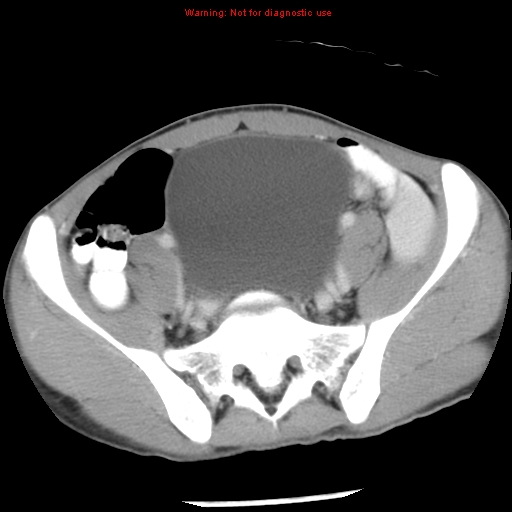 Acute appendicitis (Radiopaedia 8195-9045 Axial C+ portal venous phase 56).jpg