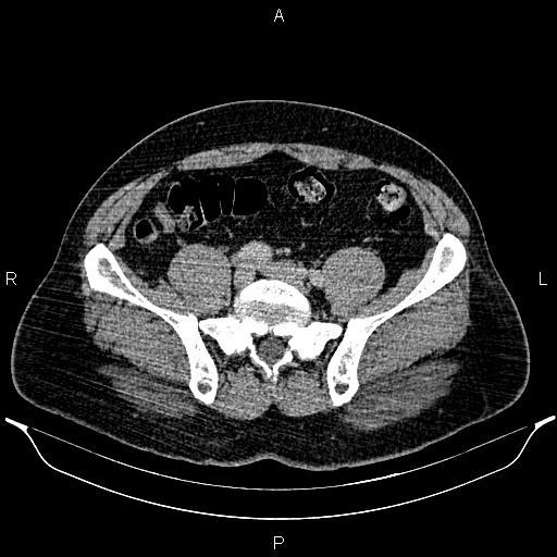 Acute appendicitis (Radiopaedia 84780-100240 Axial C+ portal venous phase 78).jpg