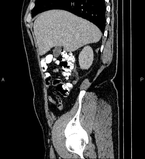 Acute appendicitis (Radiopaedia 84780-100240 Sagittal C+ portal venous phase 21).jpg