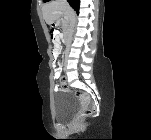 File:Acute appendicitis (Radiopaedia 9417-10099 Sagittal C+ portal venous phase 1).jpg