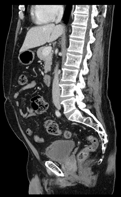Acute appendicitis - large appendicoliths (Radiopaedia 61805-69820 Sagittal C+ portal venous phase 61).jpg