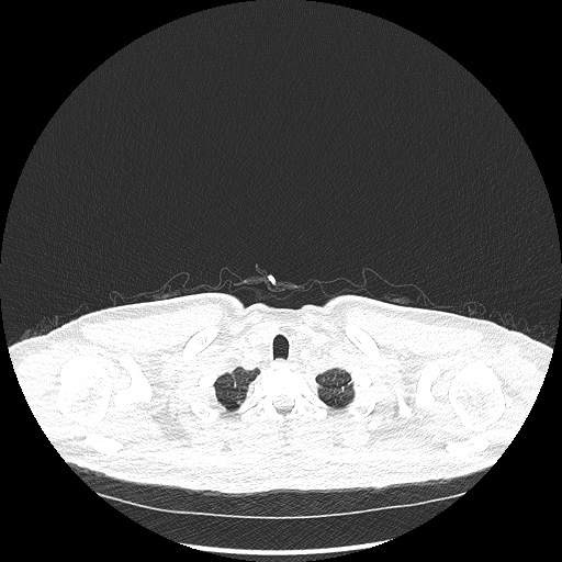 File:Acute appendicitis and COVID 19 pneumonia (Radiopaedia 76604-88380 Axial lung window 6).jpg