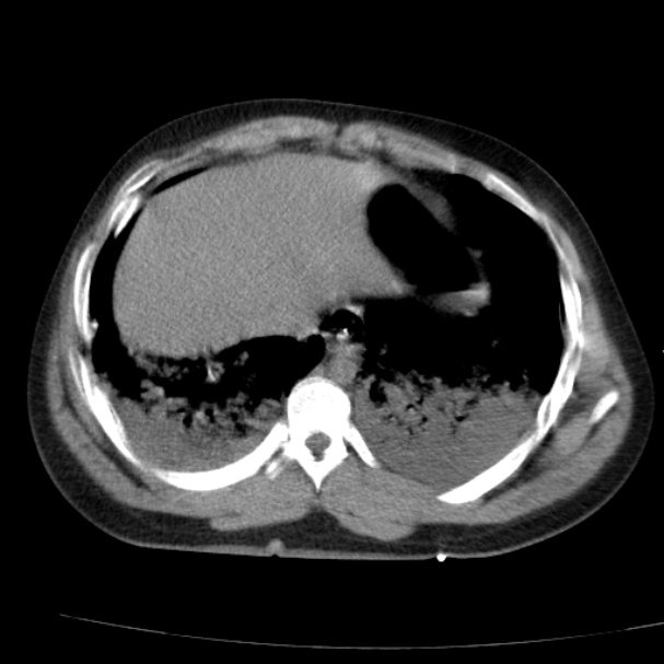 Acute aspiration pneumonitis (Radiopaedia 33605-34703 Axial non-contrast 67).jpg
