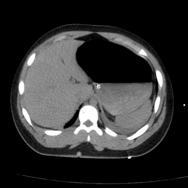 Acute aspiration pneumonitis (Radiopaedia 33605-34703 Axial non-contrast 76).jpg