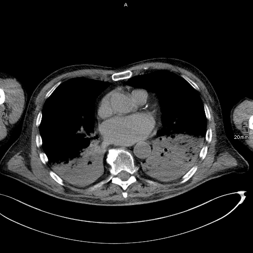 Acute aspiration pneumonitis (Radiopaedia 55642-62166 Axial liver window 37).jpg