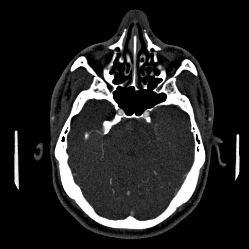 Acute basilar artery occlusion (Radiopaedia 43582-46985 Axial C+ arterial phase 57).jpg