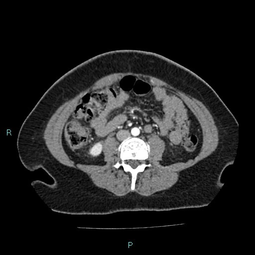 File:Acute bilateral pyelonephritis (Radiopaedia 37146-38881 Axial C+ arterial phase 111).jpg