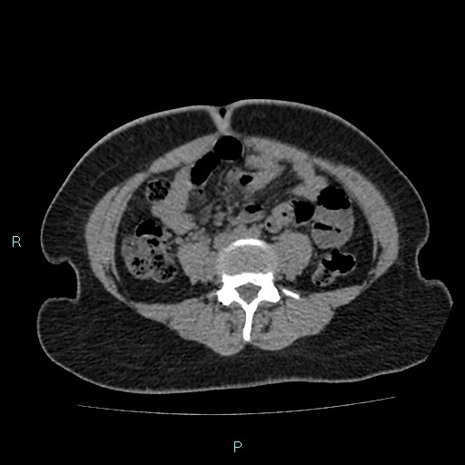 Acute bilateral pyelonephritis (Radiopaedia 37146-38881 Axial non-contrast 66).jpg