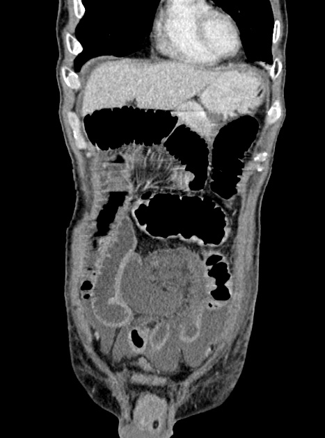 Acute bowel ischemia (Radiopaedia 87695-104114 Coronal C+ portal venous phase 114).jpg