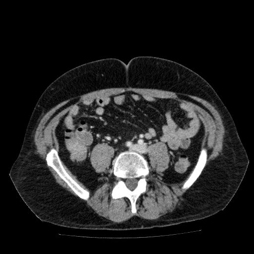 Acute cholecystitis and incidental left sided IVC (Radiopaedia 49352-54459 Axial C+ portal venous phase 100).jpg