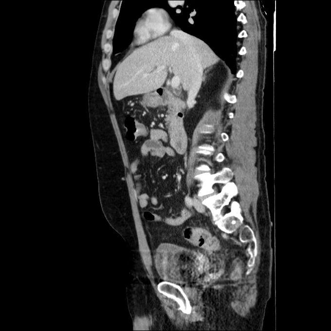Acute cholecystitis and incidental left sided IVC (Radiopaedia 49352-54459 Sagittal C+ portal venous phase 54).jpg