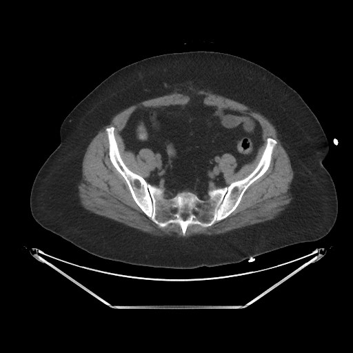 File:Acute cholecystitis with tensile fundus sign (Radiopaedia 71394-81723 Axial non-contrast 91).jpg