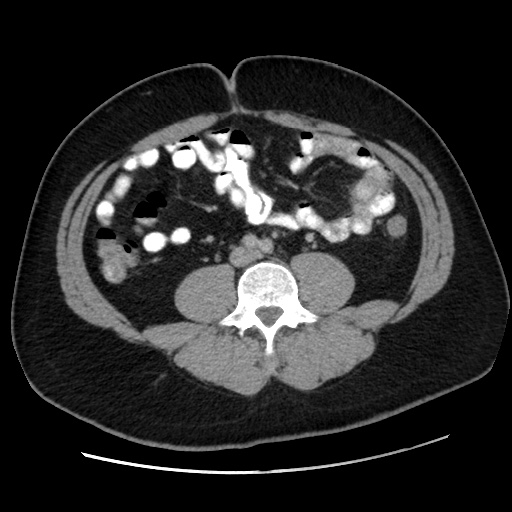 Acute diverticulitis with localized perforation (Radiopaedia 41296-44113 Axial C+ portal venous phase 53).jpg