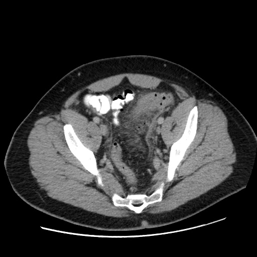 Acute diverticulitis with localized perforation (Radiopaedia 41296-44113 Axial C+ portal venous phase 76).jpg