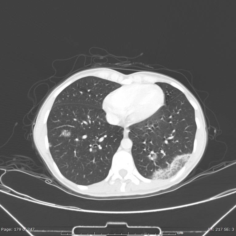 Acute eosinophilic pneumonia (Radiopaedia 48211-53073 Axial lung window 64).jpg