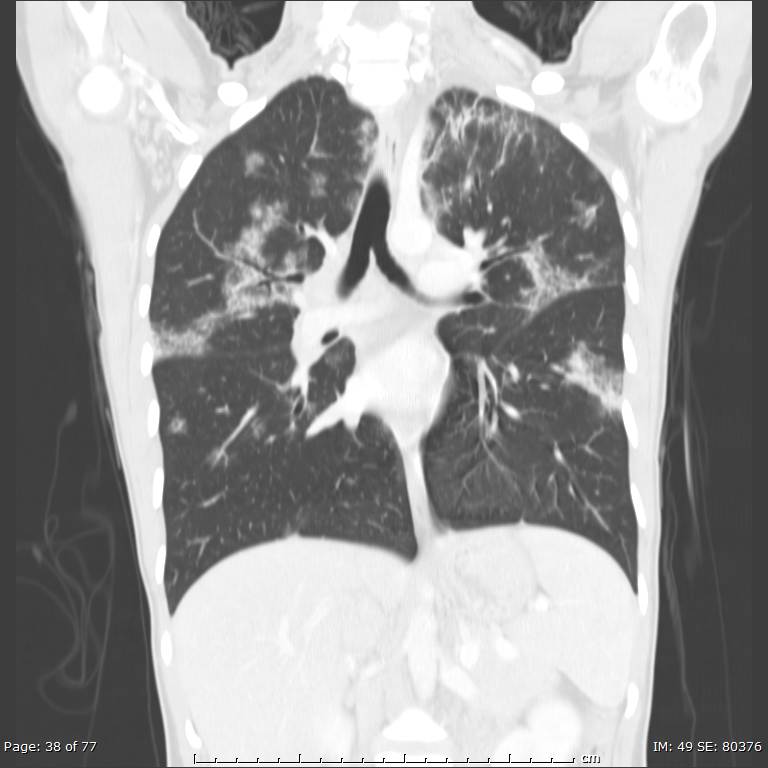 Acute eosinophilic pneumonia (Radiopaedia 48211-53073 Coronal lung window 25).jpg