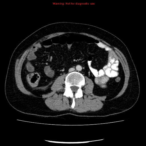 Acute gangrenous cholecystitis (Radiopaedia 10123-10661 Axial C+ portal venous phase 58).jpg