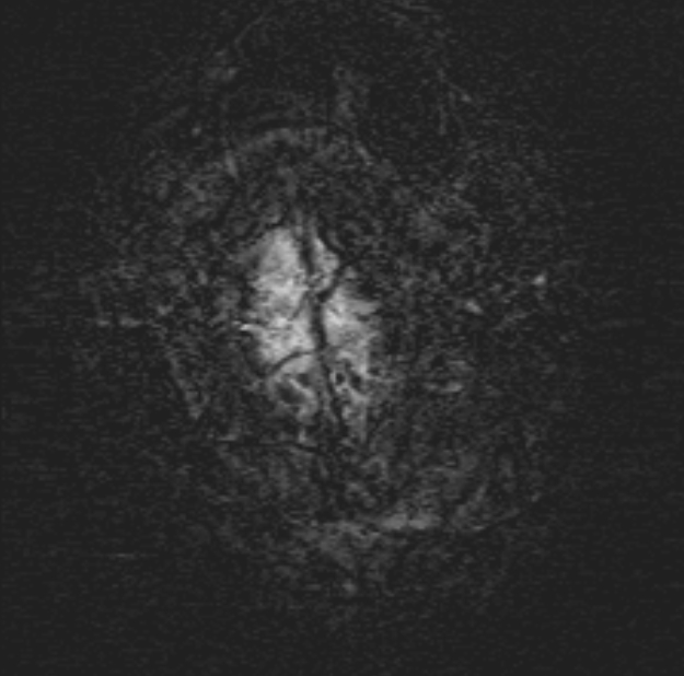 Acute ischemic stroke - posterior circulation territory (Radiopaedia 77670-89880 Axial SWI 56).jpg