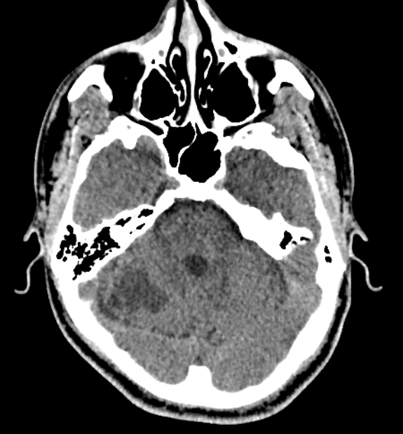 Acute ischemic stroke - posterior circulation territory (Radiopaedia 77670-89881 non-contrast 24).jpg