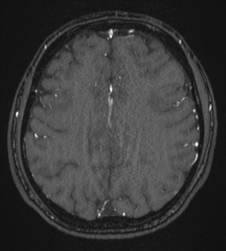 Acute left middle cerebral artery territory infarct with clot retrieval (Radiopaedia 47732-52433 Axial MRA 47).png