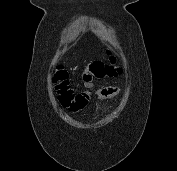 Acute mesenteric ischemia (Radiopaedia 80029-93316 Coronal C+ arterial phase 8).jpg