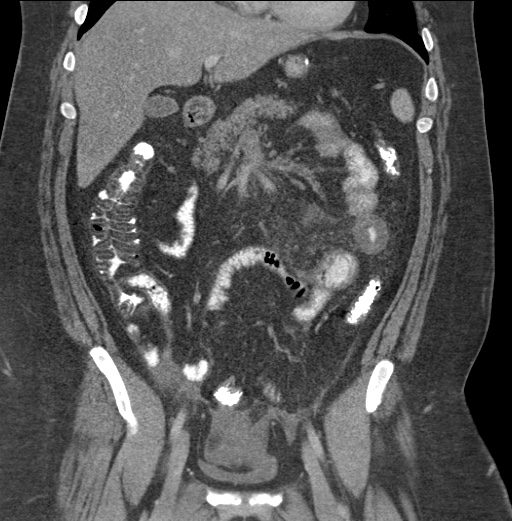 Acute mesenteric venous ischemia (Radiopaedia 46041-50383 Coronal C+ portal venous phase 41).jpg