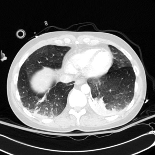 Acute myocardial infarction in CT (Radiopaedia 39947-42415 Axial lung window 104).jpg