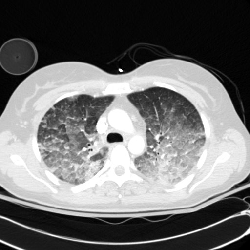 Acute myocardial infarction in CT (Radiopaedia 39947-42415 Axial lung window 38).jpg