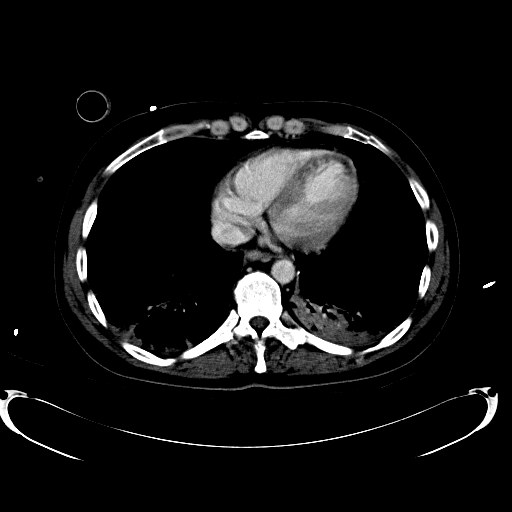 File:Acute myocardial infarction in CT (Radiopaedia 39947-42457 Axial C+ portal venous phase 8).jpg