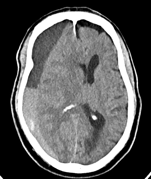 Acute on chronic subdural hematoma (Radiopaedia 78346-90966 Axial non-contrast 34).jpg