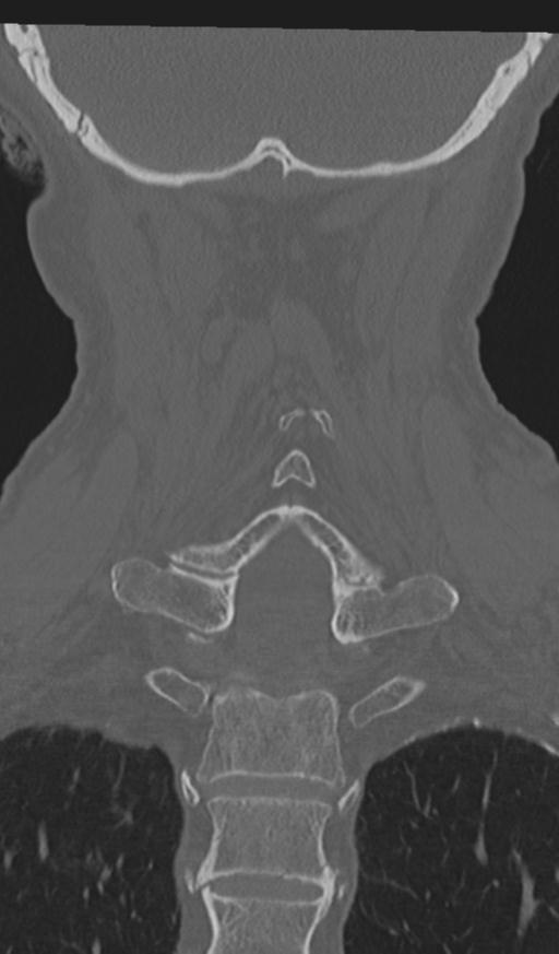 Acute on chronic subdural hematoma and thoracic vertebral injury in a multitrauma patient (Radiopaedia 31698-32619 Coronal bone window 47).jpg