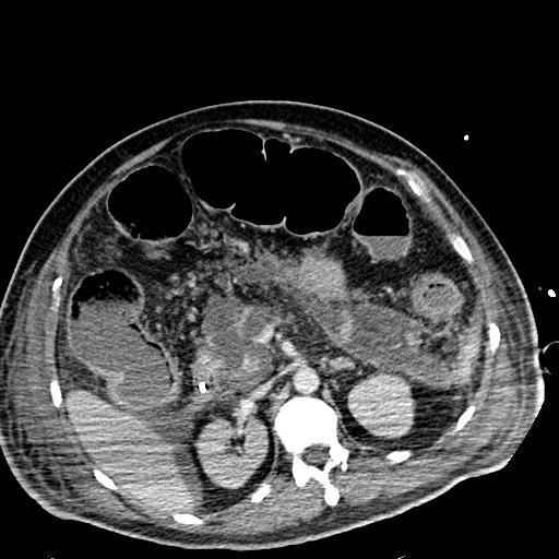 Acute pancreatic necrosis (Radiopaedia 13560-18501 Axial C+ portal venous phase 51).jpg