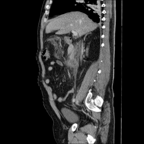 Acute pancreatitis (Radiopaedia 26663-26813 Sagittal C+ portal venous phase 29).jpg