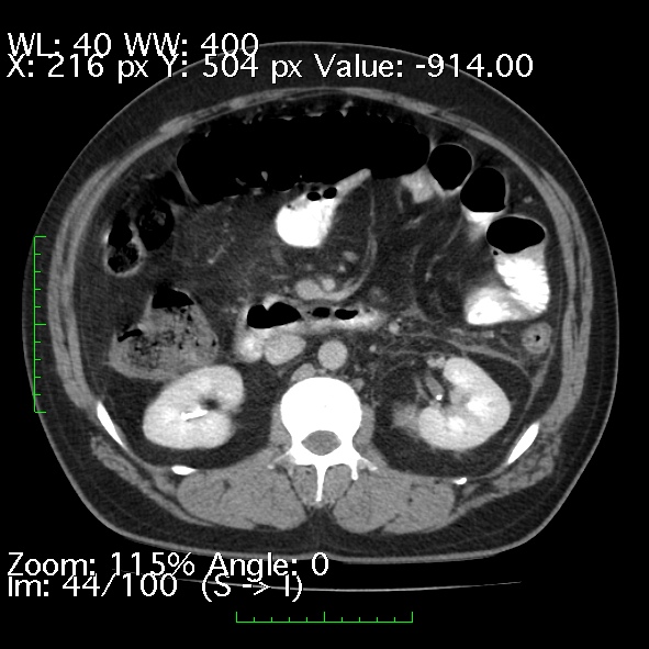 File:Acute pancreatitis (Radiopaedia 34043-35276 Axial C+ portal venous phase 44).jpg