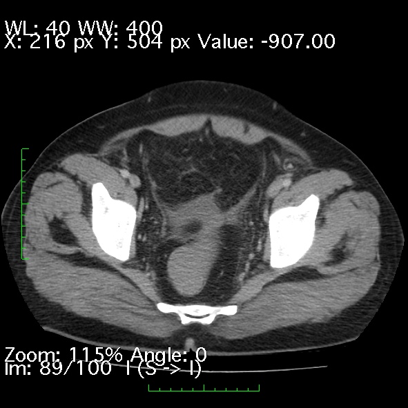 Acute pancreatitis (Radiopaedia 34043-35276 Axial C+ portal venous phase 89).jpg