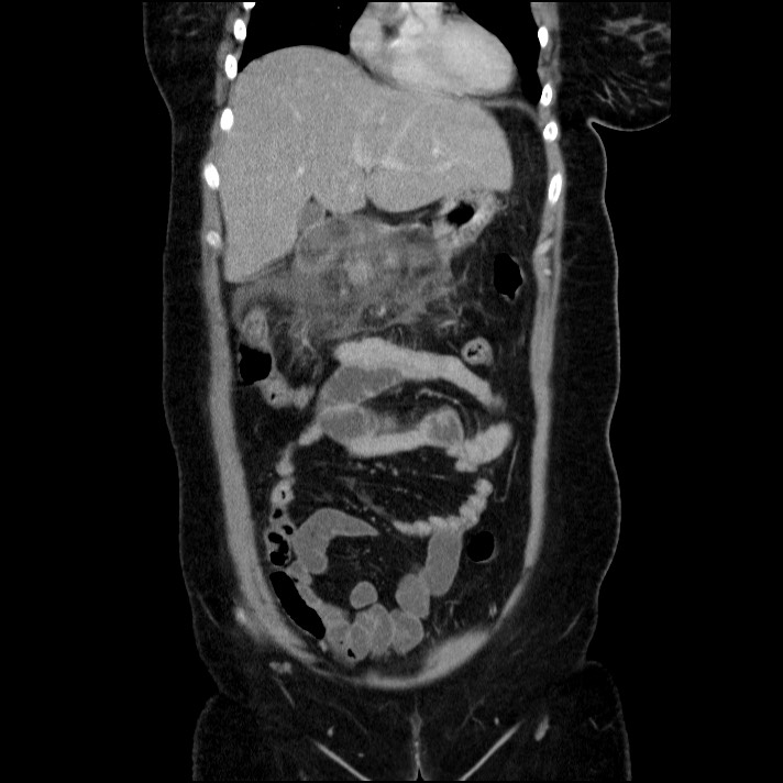 Acute pancreatitis (Radiopaedia 69236-79012 Coronal C+ portal venous phase 52).jpg
