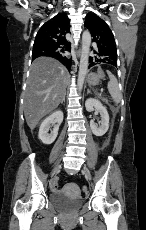 Acute pancreatitis (Radiopaedia 80007-93285 Coronal C+ portal venous phase 92).jpg