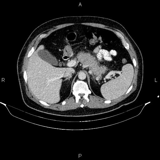 Acute pancreatitis (Radiopaedia 85390-101010 Axial C+ portal venous phase 30).jpg