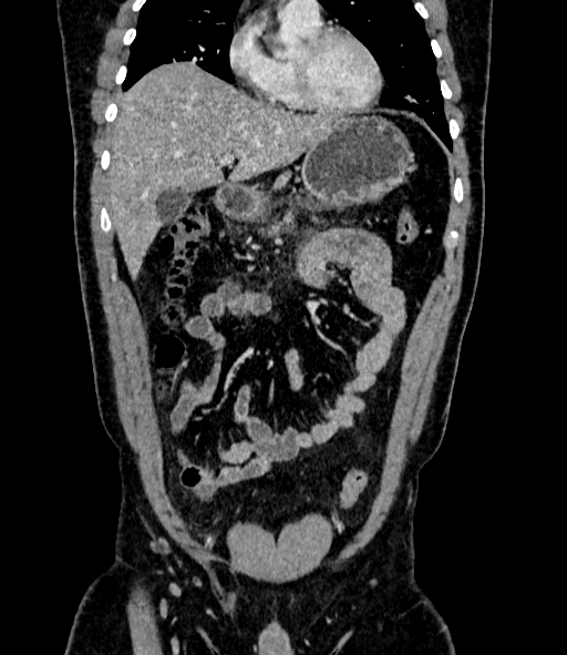 Acute pancreatitis (Radiopaedia 87428-103757 Coronal C+ portal venous phase 30).jpg
