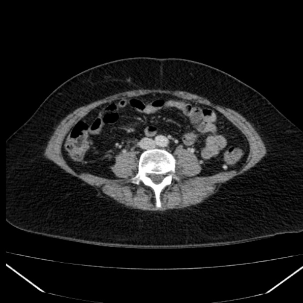 Acute pancreatitis - Balthazar C (Radiopaedia 26569-26714 Axial C+ portal venous phase 61).jpg