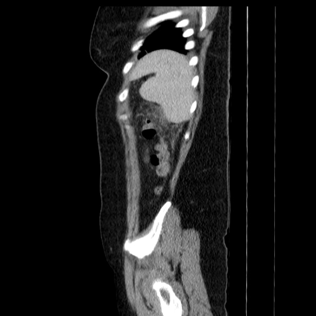 Acute pancreatitis - Balthazar C (Radiopaedia 26569-26714 Sagittal C+ portal venous phase 58).jpg