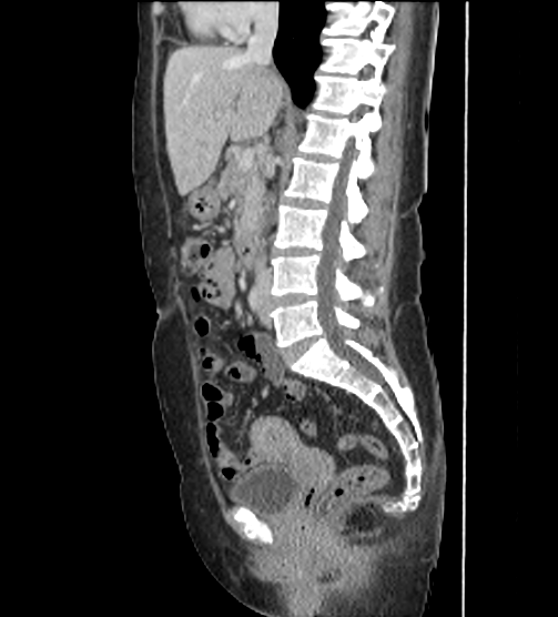 Acute pancreatitis - Balthazar E - post ERCP (Radiopaedia 27562-27772 Sagittal C+ portal venous phase 63).png