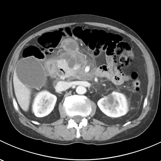 File:Acute pancreatitis and walled-off necrosis (Radiopaedia 29888-30404 Axial C+ portal venous phase 31).jpg