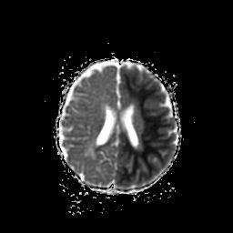 File:Acute phase of hemiconvulsion-hemiplegia epilepsy syndrome (Radiopaedia 29309-29745 Axial ADC 9).jpg