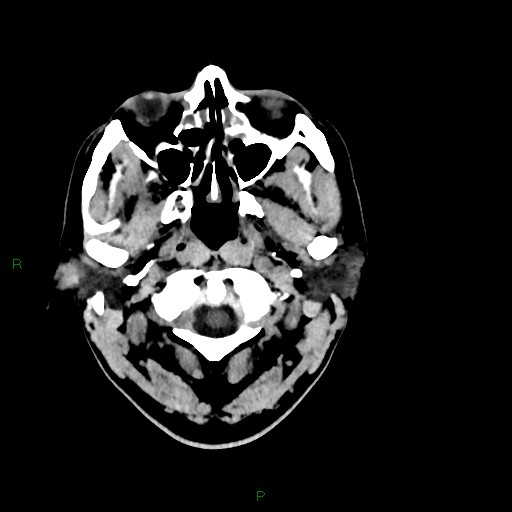 Acute posterior cerebral artery territory infarct (Radiopaedia 79329-92393 Axial non-contrast 6).jpg